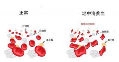 地中海贫血到底有多可怕？如何预防地贫遗传给