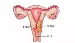 二价、四价、九价HPV疫苗有什么区别？