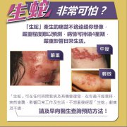 带状疱疹的症状表现【带状疱疹图片】